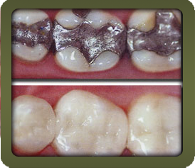 IŞINLI BEYAZ DOLGULAR - AMALGAM DOLGULAR