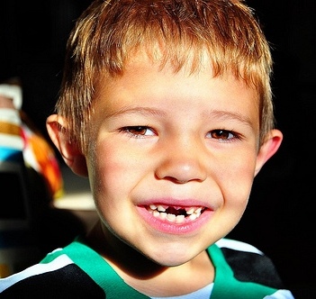 Çocuklarda acil diş yaralanmaları: Bebek dişi (süt dişi) yerinden çıkması