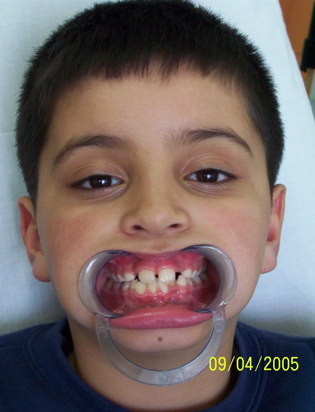 Ortodontik tedaviye başlamak için en uygun yaş kaçtır?