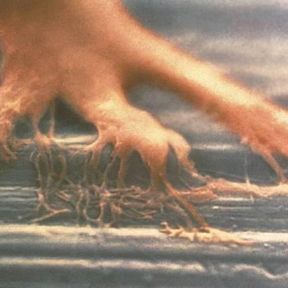 İmplant uygulaması ve diş takılması arası süre ne kadardır?