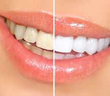 Diş beyazlatma (dental bleaching) nasıl gerçekleşiyor?