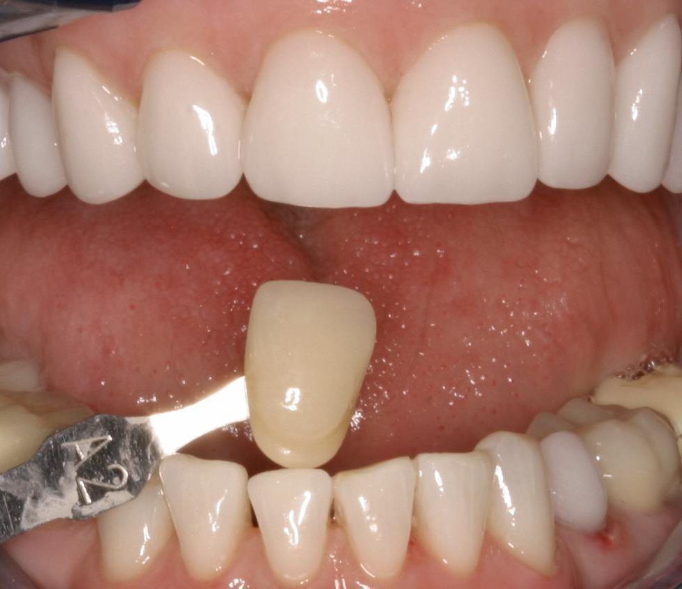 Diş rengini etkileyen faktörler ve diş beyazlatma