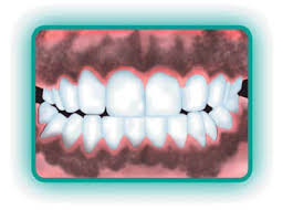 Dişeti hiperpigmentasyonunun (koyu dişeti rengi) lazer ile tedavisi