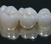 Porselen, lamina, zirkon ömrü ne kadardır ?