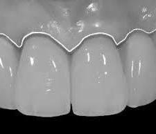 Diş protezlerinde estetik