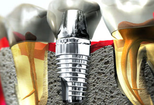 Diş sıkma alışkanlığım var, implant yaptırabilir miyim?