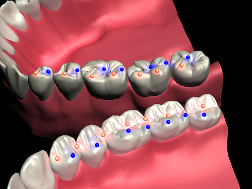 Diş sıkan bireylerde implant uygulamalarında nelere dikkat edilmelidir?
